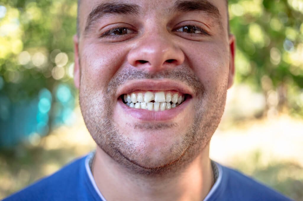 Young man in a blue T-shirt with a chipped tooth