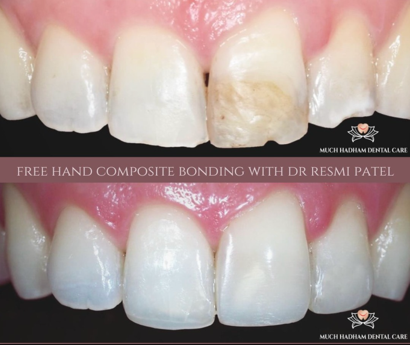 composite bonding 2