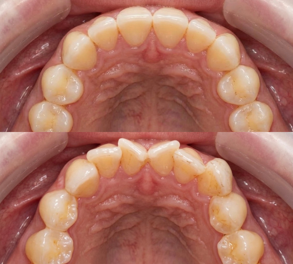 Before and after Invisalign 1