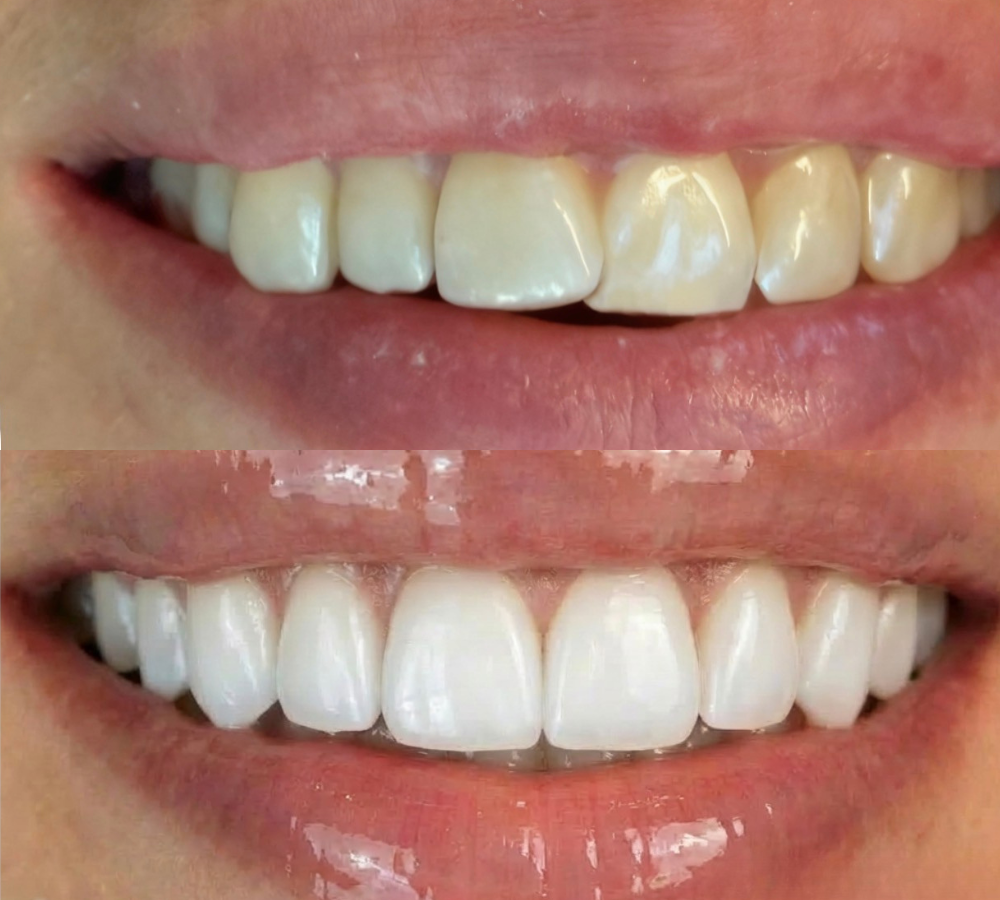 Before and after Invisalign 3
