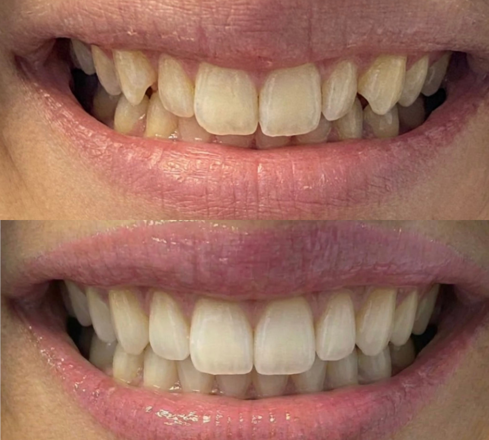 Before and after Invisalign 5