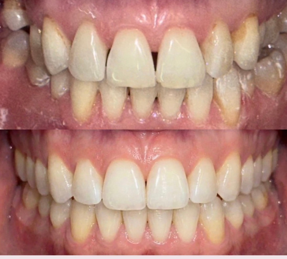 Before and after Invisalign 6