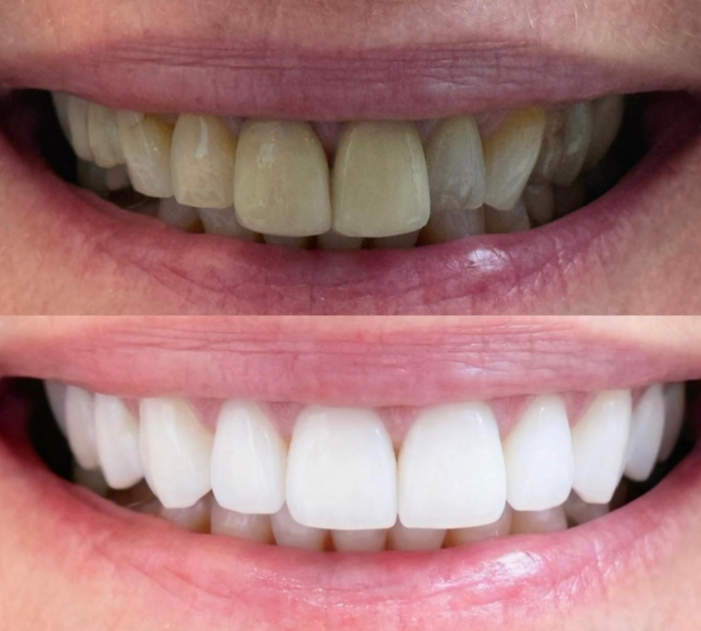 Before and after Invisalign 7