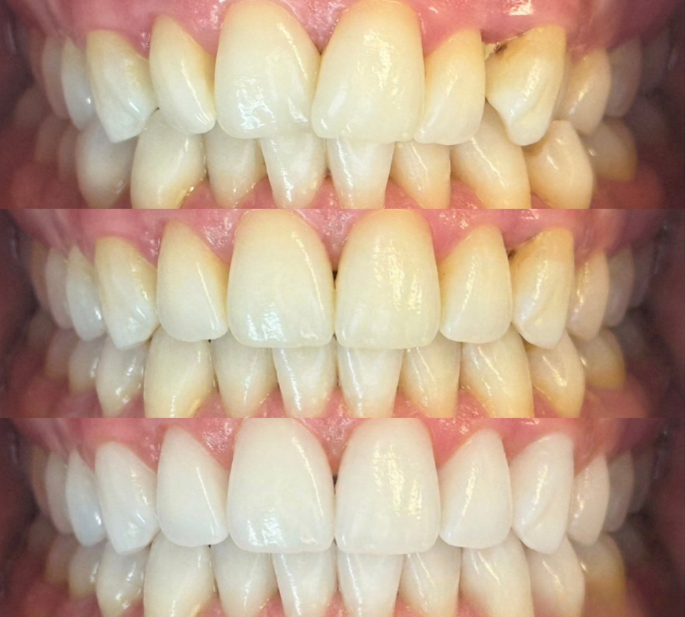 Before and after Invisalign 8