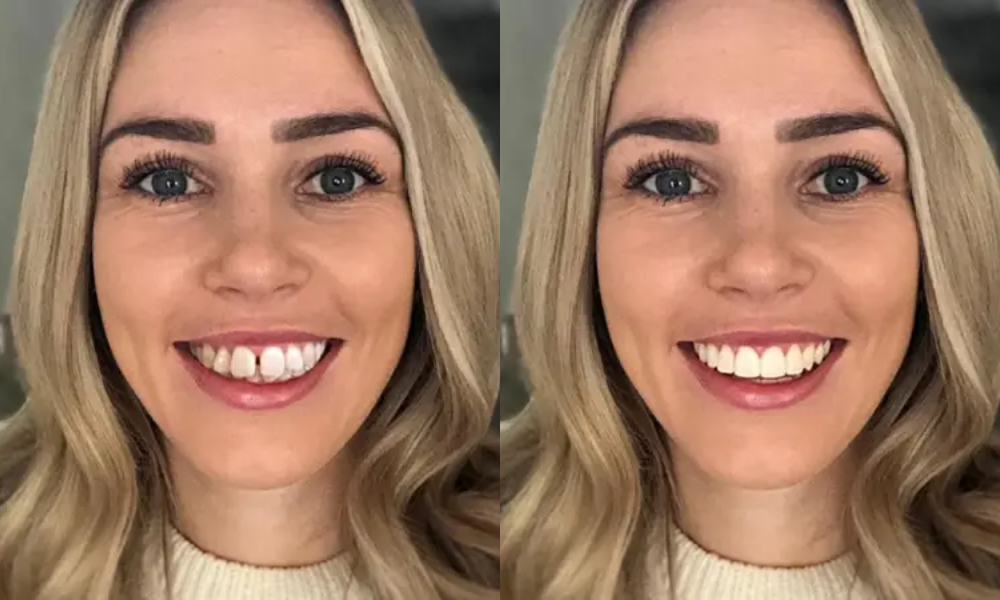 Before and after SmileView smile preview